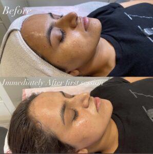 BB Glow Microneedling Facial Before and After